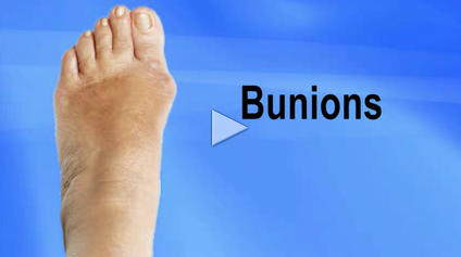 Bunion Pain